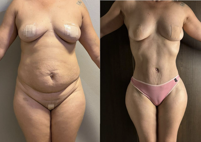 Resultado Paciente Modelo - Frente